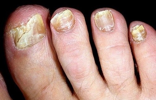 Клотримазол від грибка нігтів: розчини, мазі і креми
