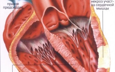 Інфаркт передньої стінки серця: наслідки та лікування