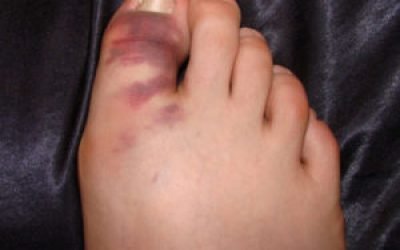 Вивих пальця на нозі: симптоми і лікування, що робити при травмі, ускладнення