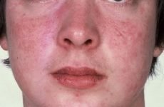 Атопічний дерматит на обличчі: лікування алергічного подразнення у дорослих