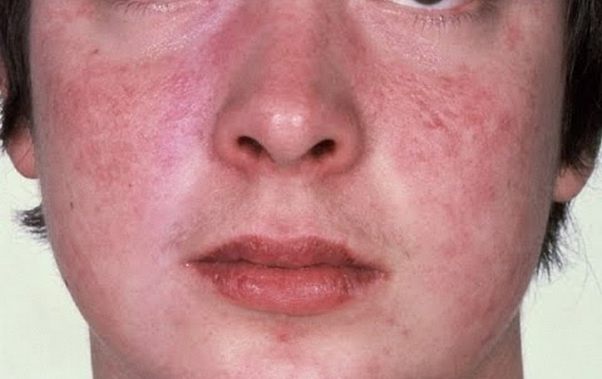 Атопічний дерматит на обличчі: лікування алергічного подразнення у дорослих