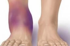 Як розробляти ногу після перелому гомілки: вправи, масаж і харчування