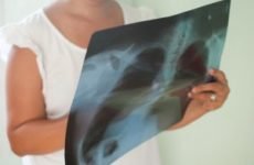 Інфільтративний туберкульоз легень – що це таке? Лікування фази розпаду верхньої частки