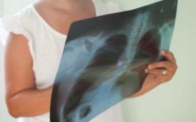 Інфільтративний туберкульоз легень – що це таке? Лікування фази розпаду верхньої частки