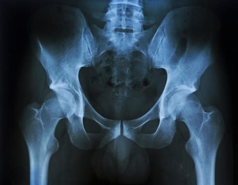 Перелом лонної кістки тазу: чим небезпечний, терміни реабілітації