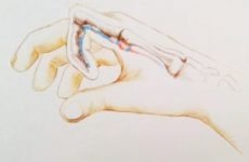 Стенозуючий лігаментит великого пальця: лікування у дітей, операція