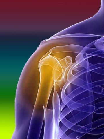 Перелом плечової кістки зі зміщенням: симптоми, види, лікування