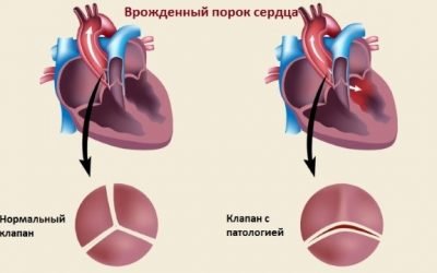 Вроджений порок серця: класифікація, причини і симптоми