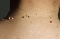 Від чого ростуть папіломи на тілі: лікування вірусного захворювання, як вивести, якщо папіломи на шиї?