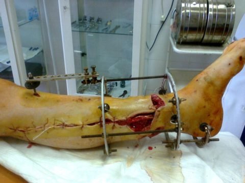 Операція при переломі гомілки – особливості будови суглоба, походження отриманих травм і хірургічні методи лікування
