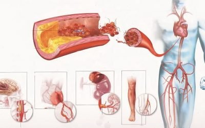 Як перевірити стан судин організму: на наявність тромбів і бляшок