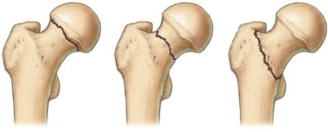 Перелом стегнової кістки: причини і особливості, діагностика та симптоматика, класифікація і лікування