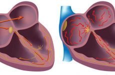 Чим небезпечна аритмія серця: миготлива і синусова