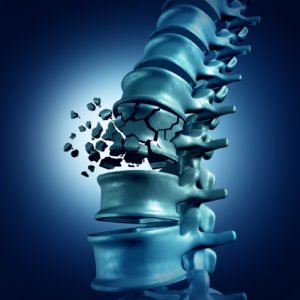 Компресійний осколковий перелом хребта: особливості травми, причини, методи діагностики та лікування