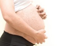 Кропив’янка при вагітності: чим лікувати і як впливають на плід?