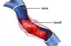 Тромбэктомия: види операцій по видаленню тромбу на нозі