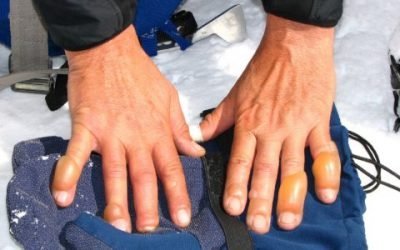 Обмороження рук – причини, симптоми, лікування