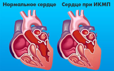 Що таке ішемічна кардіоміопатія і яка причина смерті в її випадку