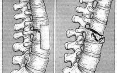Класифікація переломів хребта: анатомічні особливості і причини травми, види та симптоматичні ознаки, способи діагностики та лікування