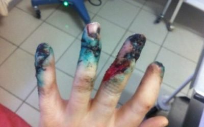 Перелом середнього пальця руки