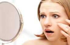 Псоріаз на обличчі: причини, специфіка проявів, методи швидкого лікування висипу