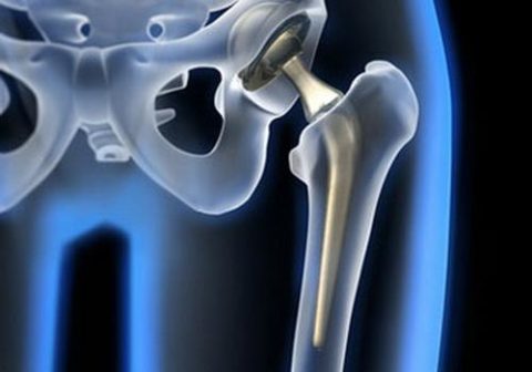 Терміни загоєння перелому шийки стегна: анатомічні особливості травми, особливості лікування та відновлення після отриманого пошкодження