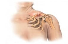 Перелом ключиці зі зміщенням: період відновлення і лікування, як розробити руку