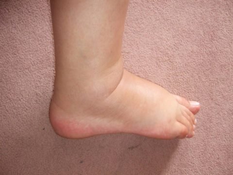Як зняти набряк ноги після перелому – препарати та народні засоби