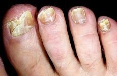 Грибок на нігтях ніг: лікування народними засобами