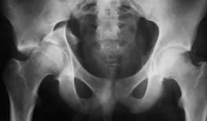 Перелом стегнового суглоба – причини та класифікація отриманої травми, лікування і варіанти реабілітації