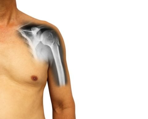Перелом голівки плеча: причини та симптоматичні особливості травми, діагностичні обстеження, рекомендації першої медичної допомоги та ефективні лікувальні методи