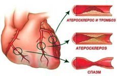 Атеросклеротичний кардіосклероз: діагностика та лікування необоротних змін міокарда
