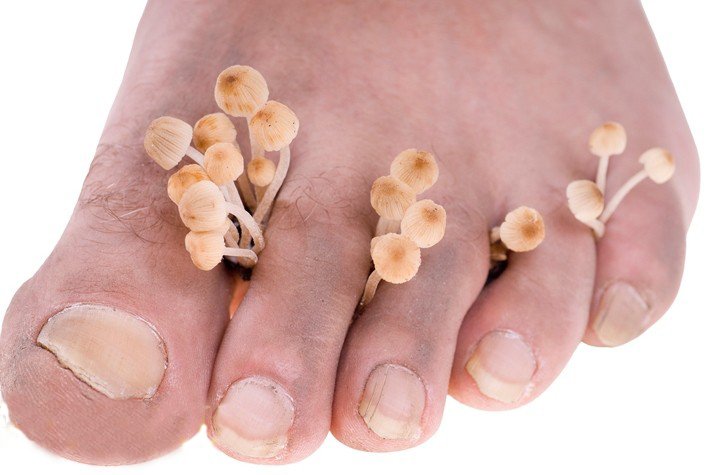 Який лікар лікує грибок нігтів на ногах: міколог або дерматолог?