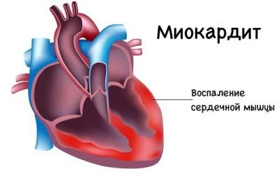 Серцевий кашель: симптоми, лікування, ознаки у літніх людей