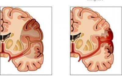 Особливості правостороннього інсульту головного мозку