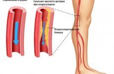 Симптоми і лікування атеросклерозу судин ніг