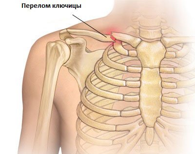 Ознаки перелому плеча при різних видах травм. Перша допомога потерпілому.