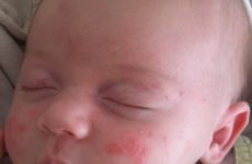 Висип у новонародженого: види, причини та способи лікування