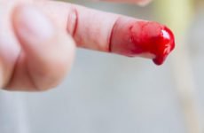 Як зупинити кров при порізі пальця: перша допомога та правила обробки рани при глибокому пошкодженні