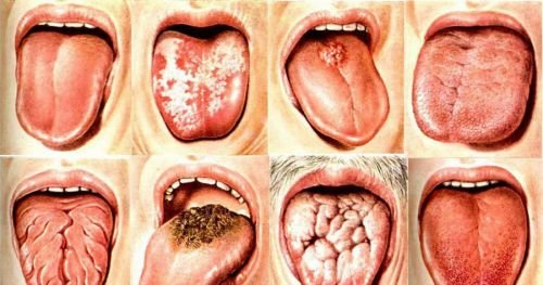 Глосит мови: симптоми і лікування, фото, як лікувати, причини у дорослих