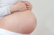 Атопічний дерматит при вагітності: лікування і причини