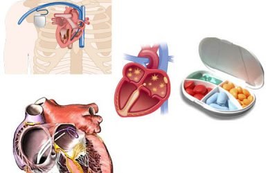 Операція по припікання при аритмії серця: чи можна робити і які наслідки