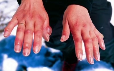 Чому лопаються судини на руках і пальцях: причини і що робити