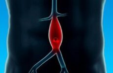 Що таке аневризма черевної аорти і які її симптоми