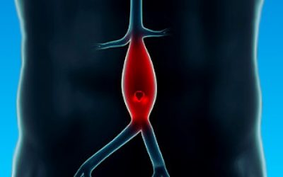 Що таке аневризма черевної аорти і які її симптоми