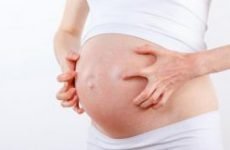 Рожевий лишай у вагітних: причини і лікування