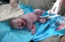 Перелом ключиці у новонародженого під час пологів: причини, лікування, наслідки
