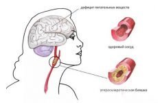 Церебральний атеросклероз судин головного мозку: симптоми і лікування