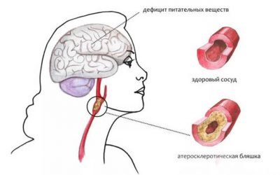Церебральний атеросклероз судин головного мозку: симптоми і лікування