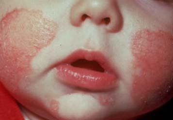Чим відрізняється атопічний дерматит від алергії: різниця симптомів та лікування